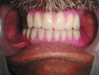 with conventional complete dentures.