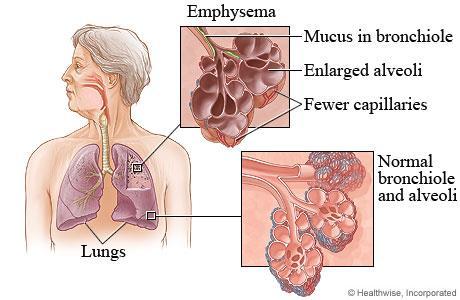 Emphysema Emphysema is permanent and irreversible because alveoli cannot be regenerated. Individuals with emphysema are chronically short of breath and unable to participate in vigorous activity.