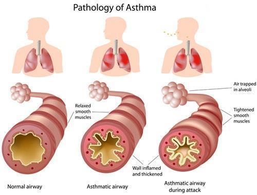 Particulates from tobacco smoke can worsen asthma.