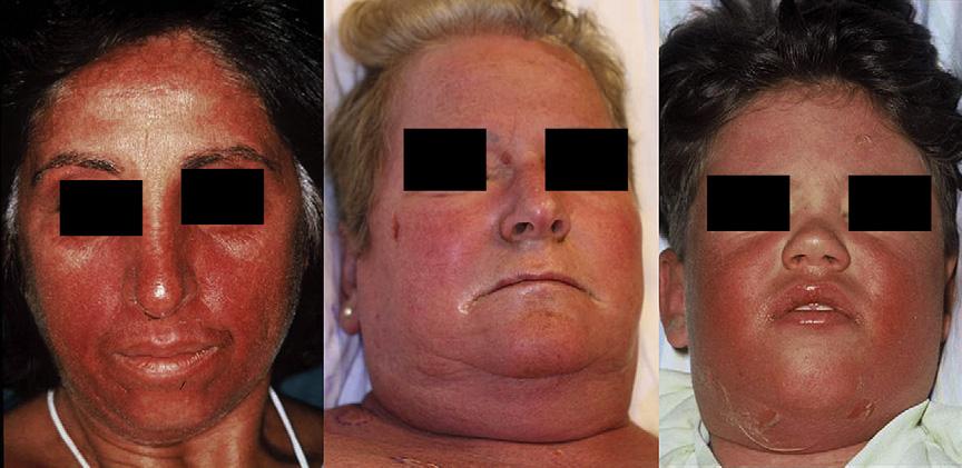 hypersensitivity reactions, such as DRESS or serum sickness like reactions. Facial edema (discussed previously) is also typical of DRESS (see Fig. 2).