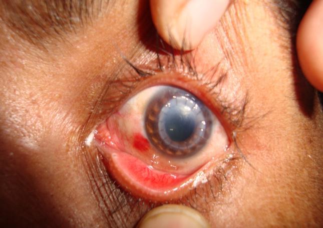 All patients with unilateral or bilateral corneal opacity are eligible for corneal transplant, were included in study and patients with Stevens-Johnson syndrome, ocular mucous membrane pemphigoid,