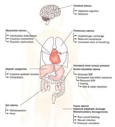Potential Clinical Consequences of Organ Edema in