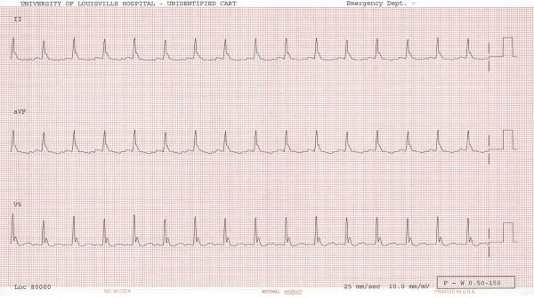 Cardiovascular Tachycardia, then bradycardia when T < 35 C Increased contractility Cardiac cycle prolongation (PR, QRS, QT) Vasoconstriction Stable or Increased BP CVP due to venoconstriction