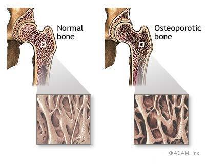 OSTEOPOROSIS = POROUS BONE A disease characterized by low bone mass and micro-architectural deterioration of bone