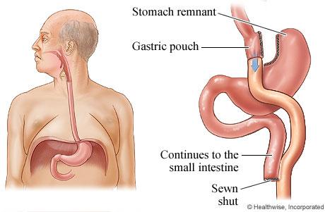 ABOUT GASTRIC BYPASS Gastric bypass surgery makes the stomach smaller and allows food to bypass part of the small intestine.