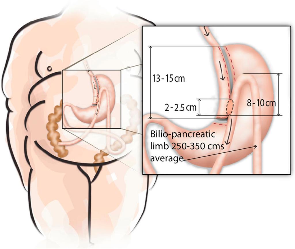1156 OBES SURG (2017) 27:1153 1167 Fig. 2 Diagrammatic representation of the oneanastomosis gastric bypass with gastric pouch ( 15 cm) and latero-lateral anastomosis.