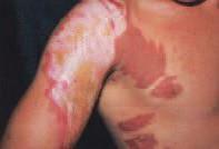 Fully circumferential burns due to possibility of causing 