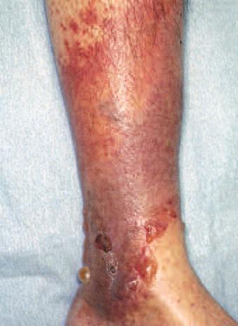 Cellulitis Wound Type Description Aims Dressings Cellulitis Other considerations Cellulitis is an infection of the skin and subcutaneous tissues Usually requires antibiotic therapy to prevent