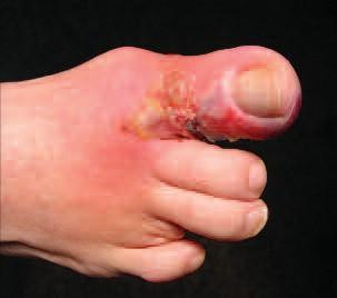 intermittent claudication Painful Minimum or no callus Area of necrosis, often surrounded by erythema Evidence of gangrene Refer to vascular surgeon Wet gangrenous wound Control moisture level Reduce