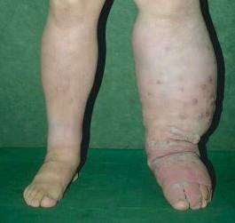 L Definition: Lymphoedema is a swelling that develops as a result of an impaired lymphatic system. This may be as a result of the lymphatic system not developing properly or through damage or trauma.