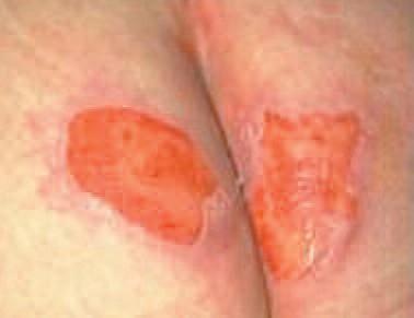 pressure to area of discolouration, upon removal peripheral flush should appear. If not and area remains discoloured treat as grade one pressure ulcer.