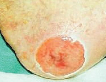 Pressure Ulcers Pressure Ulcers Pressure Ulcer Grade Description Additional Management GRADE THREE Definition: Full-thickness skin loss involving damage or necrosis of subcutaneous tissue that may