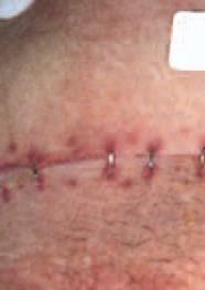 Sutured/Stapled Wound Sutured/Stapled Wound Wound Type Description Aims Dressings Other Considerations A surgically created wound, or laceration with no skin loss whose edges can be brought together