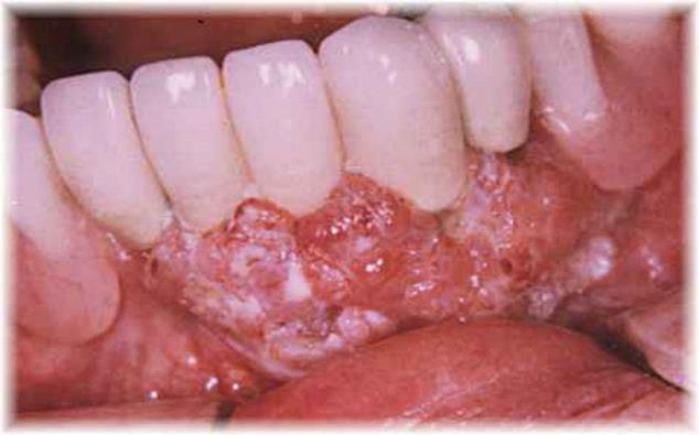 Discoloration of the teeth and