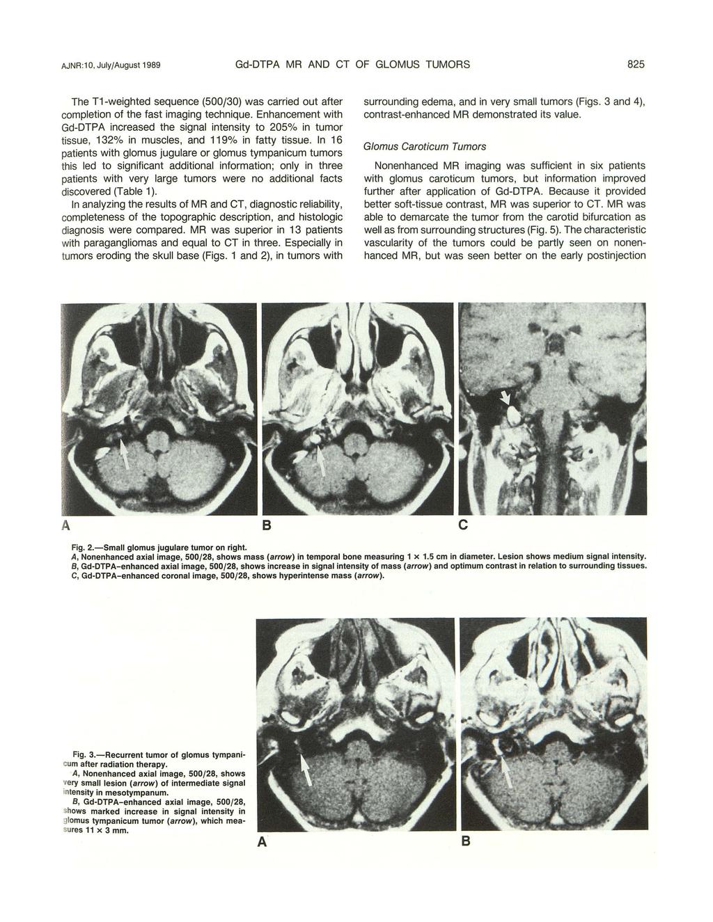 AJNR:1 0, July/August 1989 Gd-DTPA MR AND CT OF GLOMUS TUMORS 85 The T1-weighted sequence (500/30) was carried out after completion of the fast imaging technique.