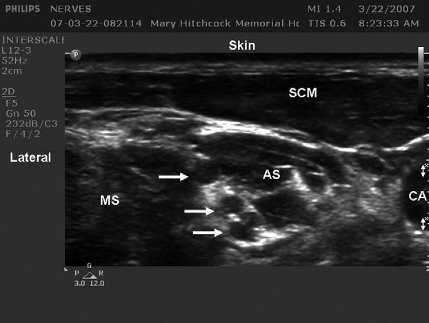 414 Regional Anesthesia and Pain Medicine Vol. 32 No. 5 September October 2007 Fig 3. The short axis view of the sciatic nerve in the popliteal fossa. This image comes from an athlete.