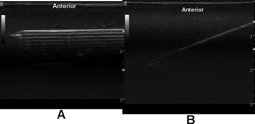 Ultrasound Physics Sites et al. 415 Fig 5. (A) Long axis image of an 18-gauge needle inserted in-plane with the ultrasound beam.