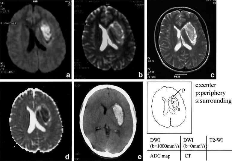 908 Table 1. s with acute intracerebral haematoma Age (years), sex Time of MRI (h:min) Site Volume (ml) 1 28, F 0:40 Basal ganglia 62.4 2 88, F 1:00 Thalamus 5.8 3 46, F 1:20 Thalamus 6.