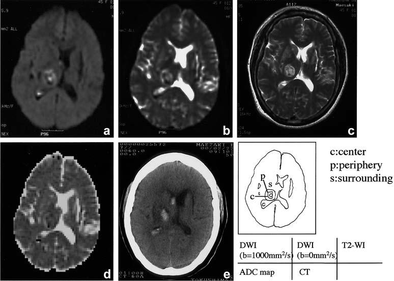 909 Fig. 2a e. 3. MRI 80 min after the onset of symptoms shows a 6.4 ml right thalamic haematoma. a, b On DWI its centre shows homogeneous high signal and a lowsignal rim.