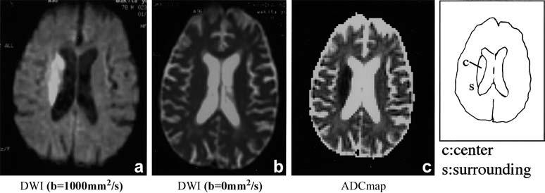 e CT shows a right thalamic haematoma that the centre and the outer high-signal area had slightly lower and much higher ADC, respectively, than normal white matter.