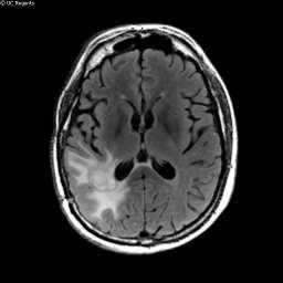 Case 2 Progression True Progression Pseudoprogression Before MRI Gad T1