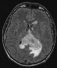 neurological status Enhancing tumor area = Weaknesses Measurement