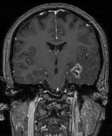 Resection Median PFS ~ 7 mo Classic Radiation Changes Dx Radiation R.T. Three categories of radiation encephalopathy: 1. Acute 2. Earlydelayed 3.