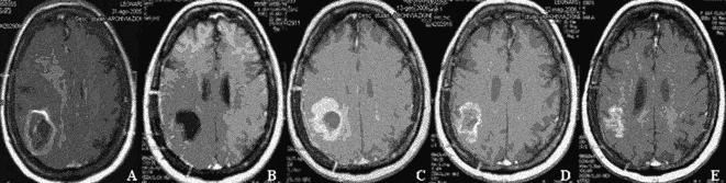 Pseudoprogression in a 65yearold patient with GBM Brandes et al, NeuroOncology 2008; 10: 3617 DSC