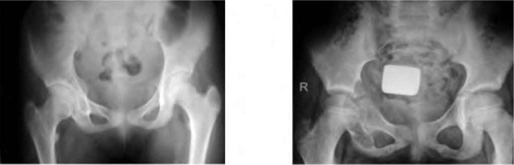 452 Primary Treatment of Aneurysmal Bone Cyst Fig. (3): (Same patient in Figs.
