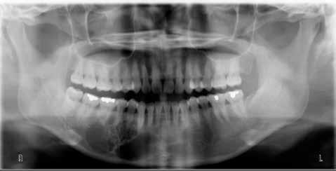 c Figure 1. Ameloblastoma affecting right mandible. a b d Figure 2.