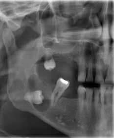 non-vital tooth. This margin, however, may not always be present in the case of infection or rapidly expanding cysts (Figure 3).
