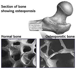 Bone Loss- Osteopenia or Osteoporosis with hormone therapy Percent change 1 0-1 Total hip P=0.