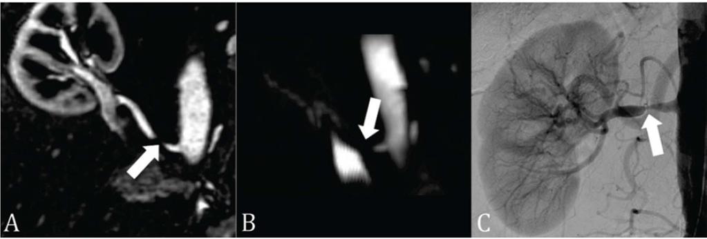Phase Contrast (PC )MRI Signal void indicates stenosis with important consequences in the hemodynamics of blood