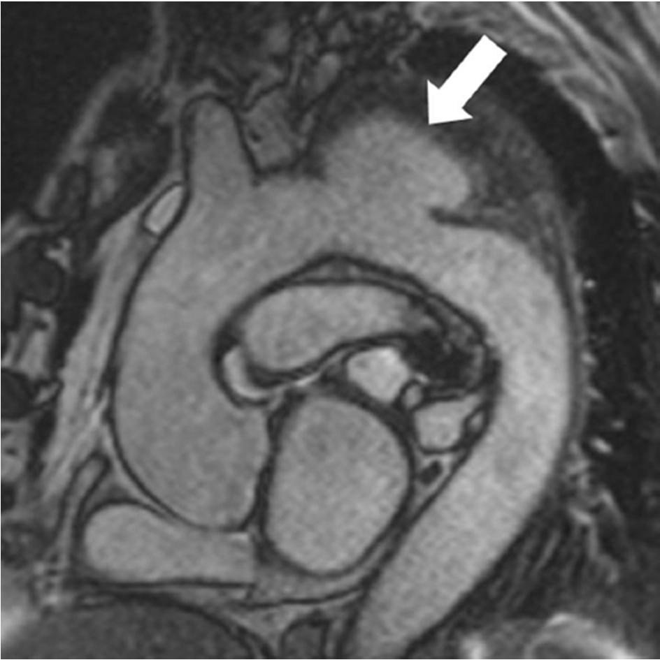 SSFP MRA Patient with a saccular