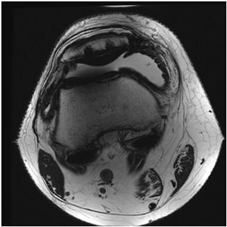 MARS prosthesis imaging Axial T2 Summary MRI plays an indispensable role in the