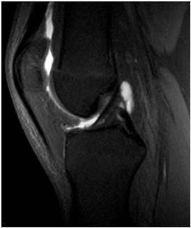 MR Knee Arthrography Infrequently Performed Allows T1