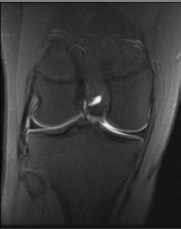 in cartilage and postoperative meniscus assessment