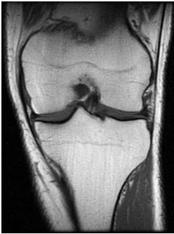 saturation MR Arthrogram Knee Loose Osteochondral Lesion
