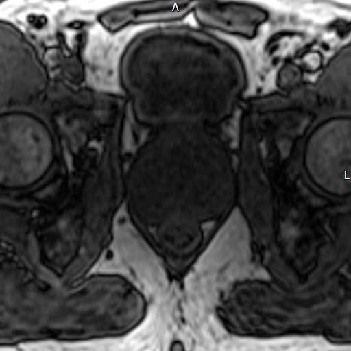 Prostate MRI Pulse Sequences DCE Tissue