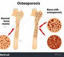 Hormone therapy effectively prevents postmenopause osteoporosis and fractures Women in the estrogen-alone and estrogenprogestogen therapy overall cohorts in the WHI had significant 33% reductions in