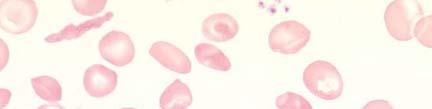 SCD exhibits a form of mild chronic low grade inflammatory state In SCD,