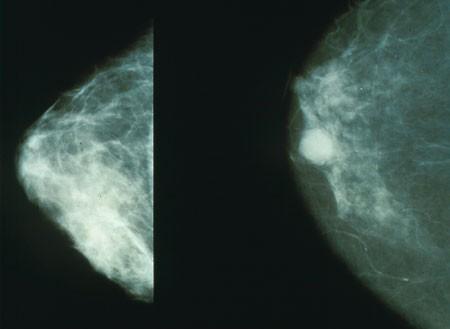 Mammograms showing a normal breast