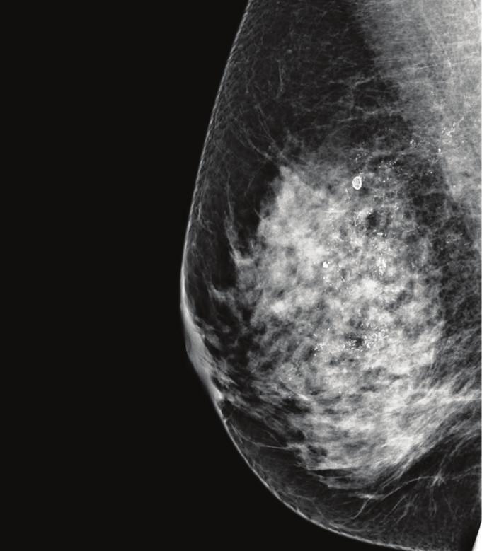 2 Case Reports in Surgery RMLO RMLO 12-23-09 6-02-10 RCC RCC 12-23-09 6-02-10 (c) (d) Figure 1: Comparison of mammographic studies before and after neoadjuvant chemotherapy.
