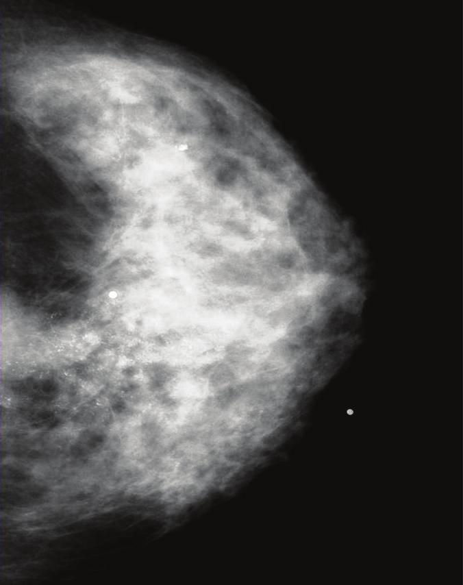 The yellow arrows indicate additional malignantappearing microcalcifications occupying the upper part of the right breast. Right MLO view after neoadjuvant chemotherapy.
