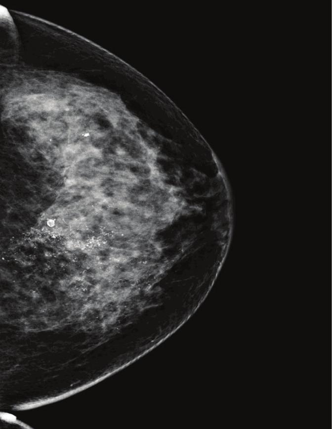 (c) Right CC view prior to neoadjuvant chemotherapy. The yellow arrows indicate the areas of microcalcifications. The blue arrow indicates the breast mass.