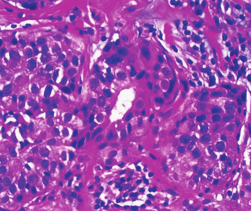 Case Reports in Surgery 3 Figure 2: Pathologic findings from core needle biopsy before neoadjuvant chemotherapy. H & E stain showing high-grade invasive carcinoma.