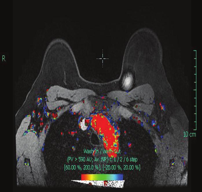 Doppler flow MRI after neoadjuvant chemotherapy shows complete radiologic response. The yellow arrow points to the normal-appearing right axillary lymph node.