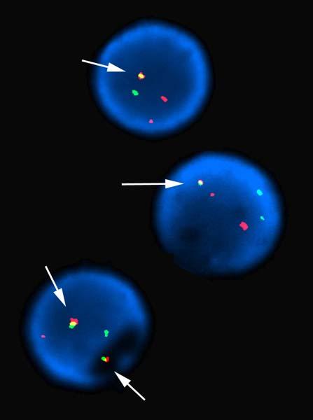 FISH 21% Ph chromosome 51% Ph chromosome and additional small green signal 4% additional copy Ph chromosome 6%
