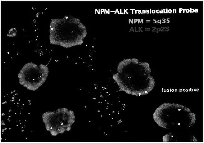 FISH to Identify NPM/ALK Fusion Gene http://www.pathologyoutlines.com 35 Genetic Testing/Cytogenetics Appelbaum, MD, Frederick R.