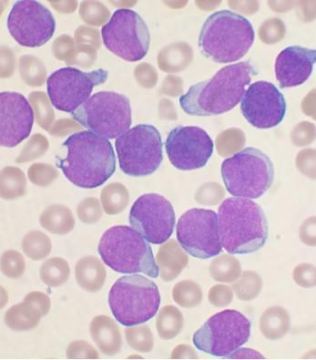 In leukemia, the marrow is replaced by blasts (primitive cells).
